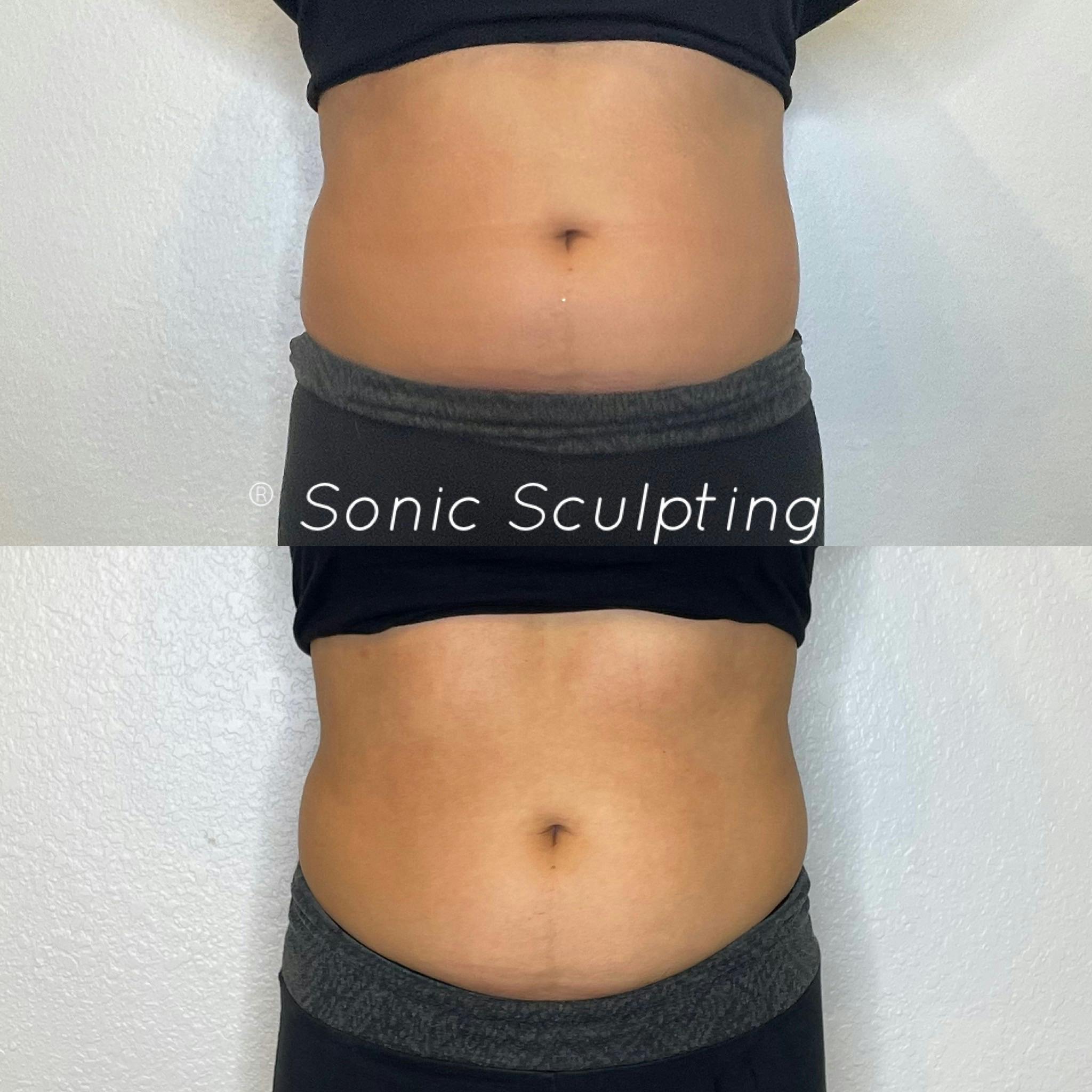 Fat Reduction + Skin Tightening  (stomach + sides)