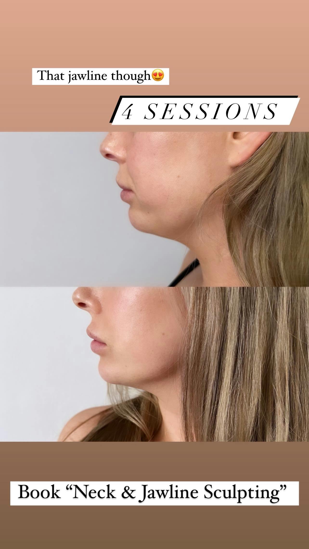 Neck and Jawline Sculpting 