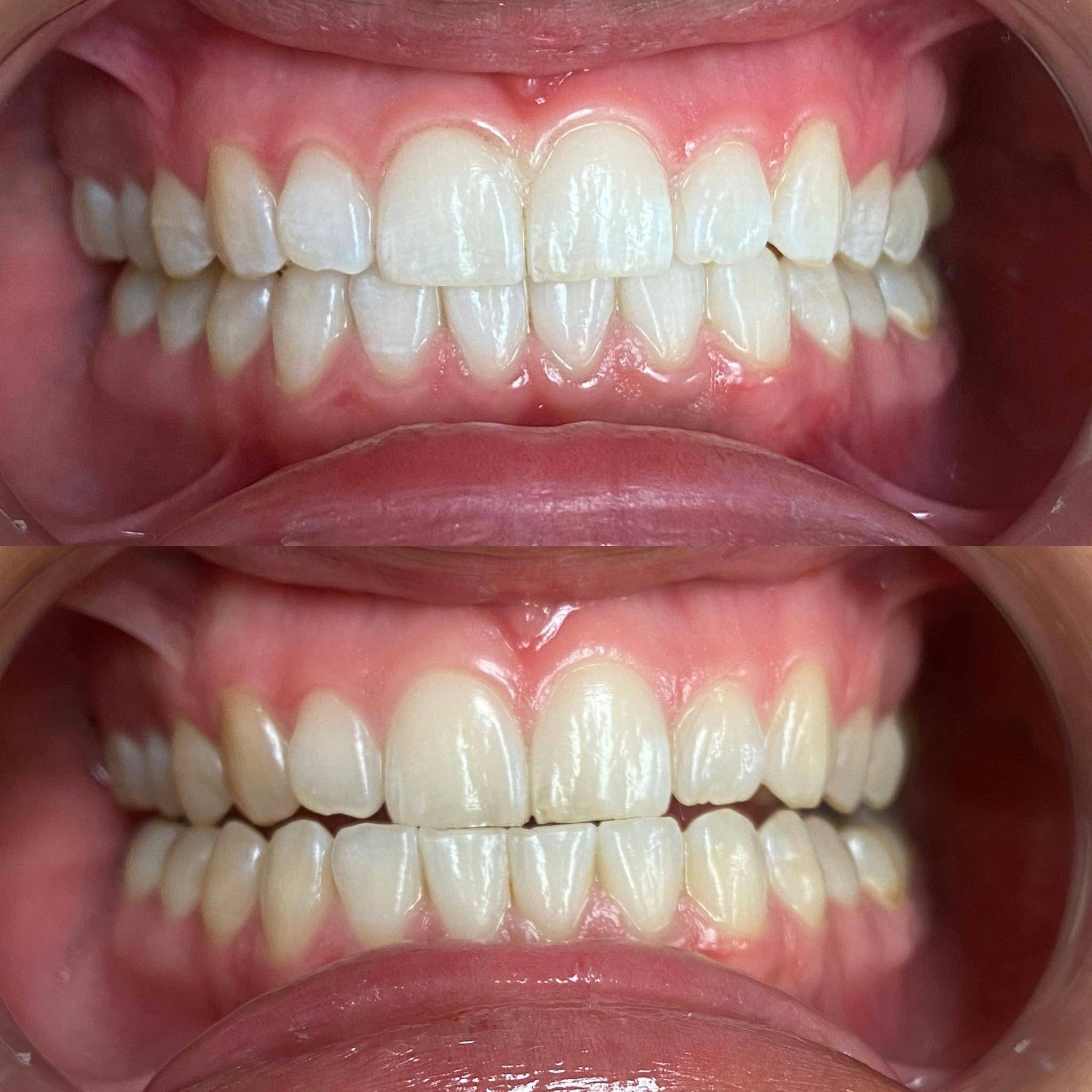 Advanced Teeth Whitening 