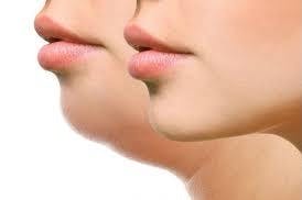 Chin Sculpting/Jaw Contouring