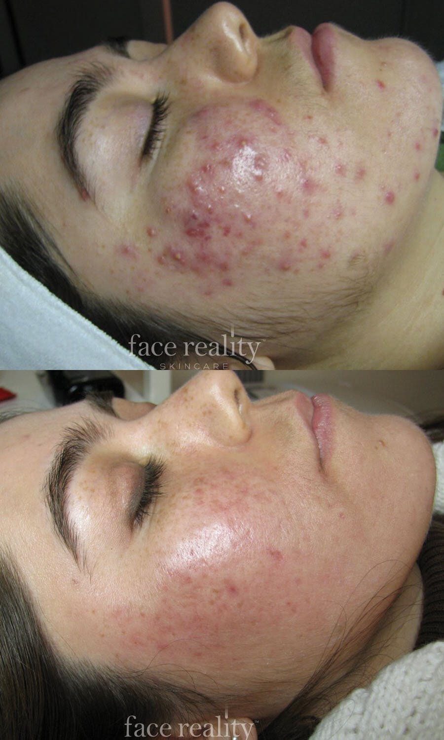 Face Reality Acne Bootcamp In Person Entry