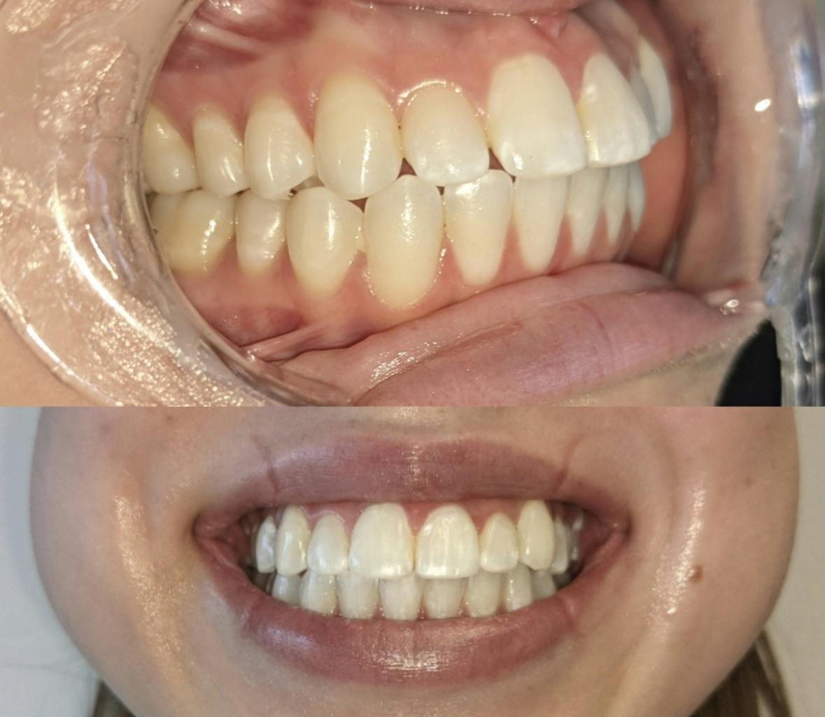 1 Person 90min Teeth Whitening