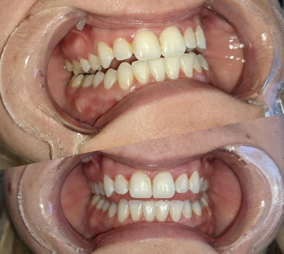 1 Person 1 hr Teeth Whitening