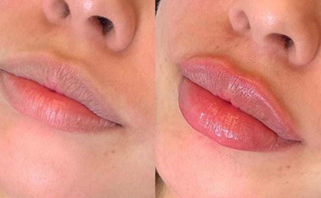 Hyaluronic Lip Enhancements 