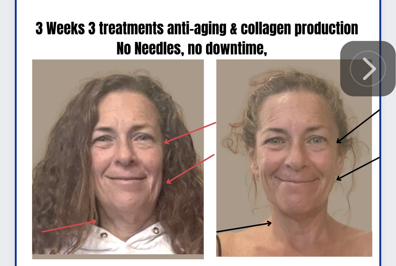 Anti-Aging Facial Rejuvenstion